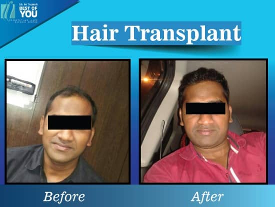 hair transplant before after